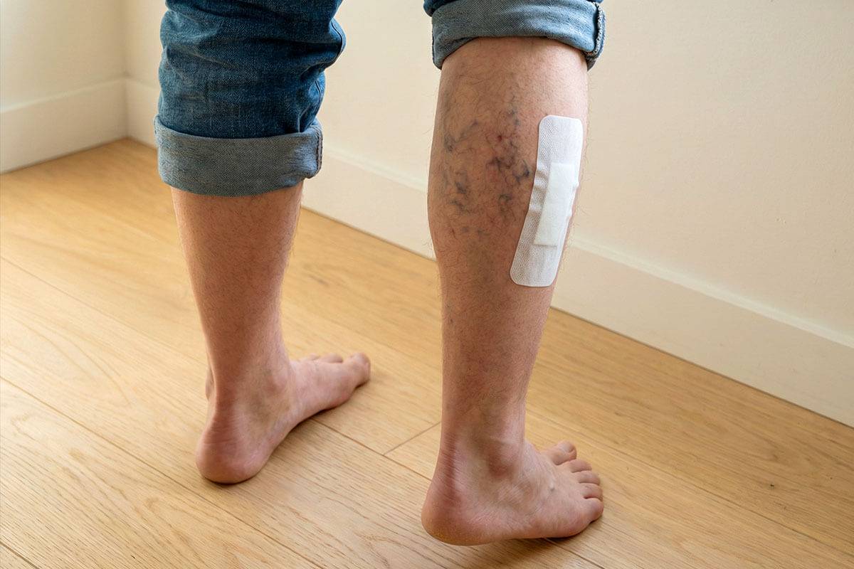 Mann mit BioRelax Pad-Pflaster an der Wade